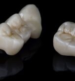 Zirconia Crown vs Ceramic Crown: Which Looks More Natural?